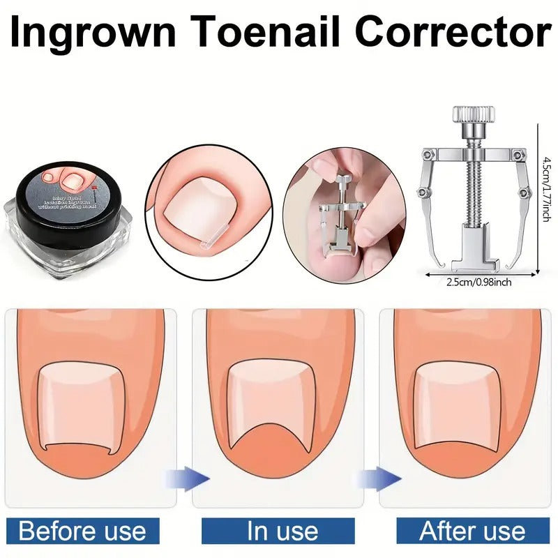 Ingrown Toenail Clippers Kit