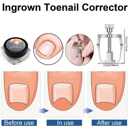 Ingrown Toenail Clippers Kit